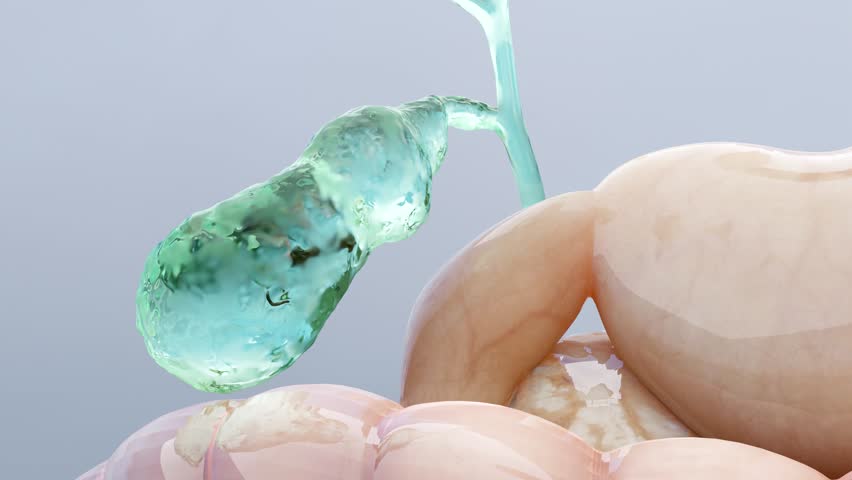 Gallstones in the gallbladderand bile duct, human silhouette and anatomy of surrounding organs, liver and gallbladder with stones, Realistic 3D Render Royalty-Free Stock Footage #1100338087