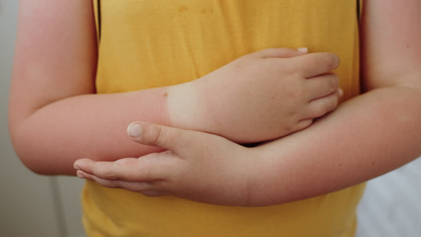 Child in yellow t-shirt holds folded hands in front of him with painful sunburns, close-up. Boy hands are burned by sun, delicate light skin reddened with spots, slow motion. Royalty-Free Stock Footage #1100371993