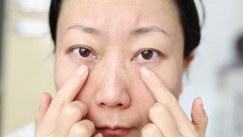 A Asian woman checks the dark circles under the eyes. worried female hands touch face and eye bags.  Royalty-Free Stock Footage #1100511983