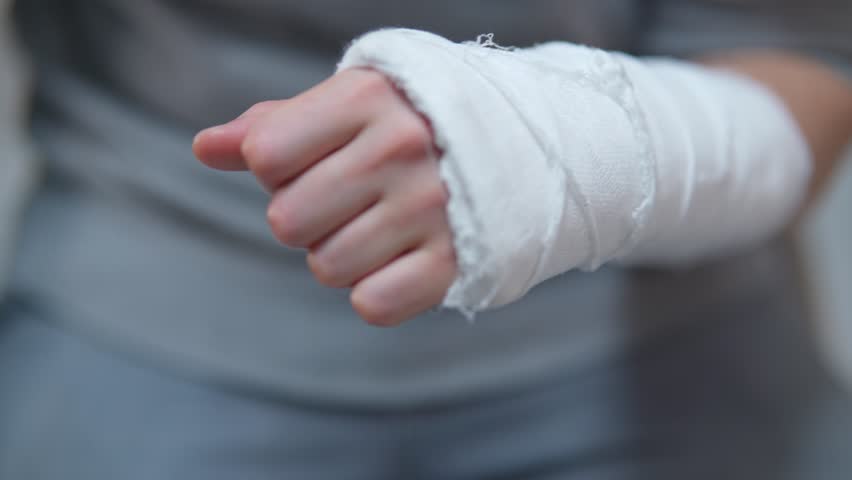 Man with plaster cast on arm. The difficulty of self-movement of the hand at a fracture. Painful heavy movements of broken finger hands close-up.