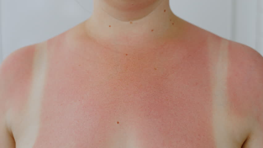 Woman applies white foam on irritated, reddened skin with sunburn in neckline after sunbathing, close-up. Person applying lotion to soothe burnt skin after exposure to ultraviolet rays, slow motion. Royalty-Free Stock Footage #1100659899
