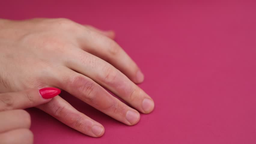 Man with burn on her hand, closeup. Burn blister on the hand. Hand male with blisters due to burns