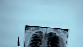 Close-up, Doctor with an X-ray of the lungs in his hands in the operating room. A doctor carefully analyzes an x-ray of a person's lungs in a hospital. Lung damage on ultrasound, pneumonia. Health