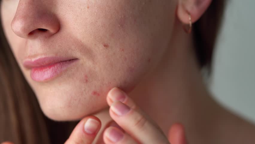 Young woman suffering from problem skin. Skincare | Shutterstock HD Video #1101053621