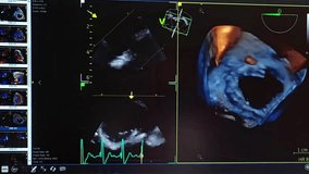 Transesophageal echocardiogram with severe mitral valve leak