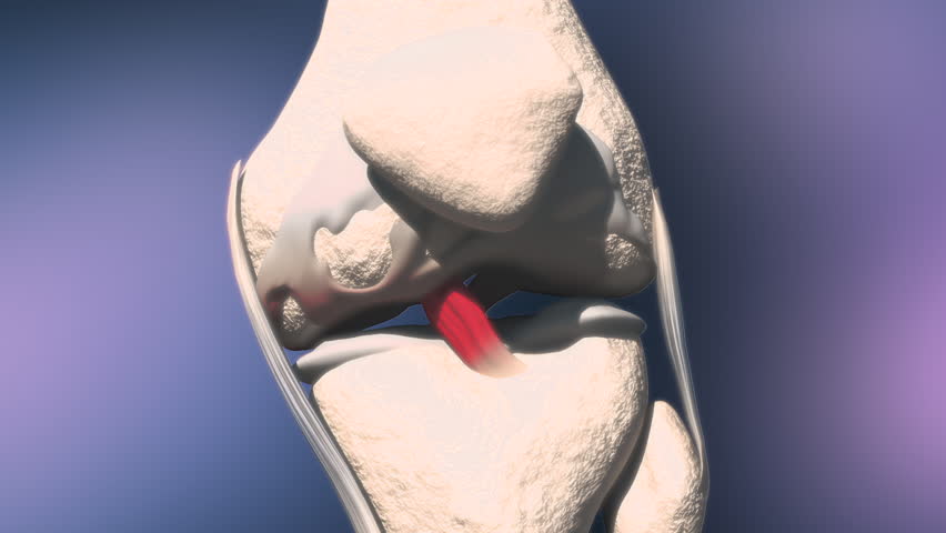 Lesion of the knee cartilage, Knee bone animation, Knee treatment. Animation of knee pain, 3D Animation Healthcare, Modern medical science. Scientific background. | Shutterstock HD Video #1101128823