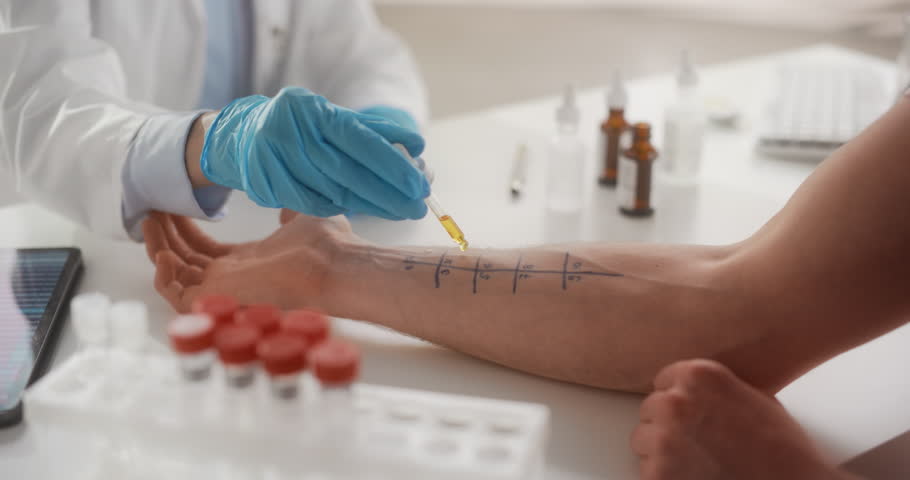 Close Up of a Patient Passing a Prick Scratch Allergy Test. Allergist Using Different Allergens on a Skin of a Young Man. Immunologist Diagnosing Allergy Triggers Royalty-Free Stock Footage #1101315713