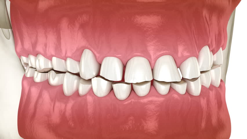Dental attrition (Bruxism) resulting in loss of tooth tissue. Dental 3D animation Royalty-Free Stock Footage #1101436773
