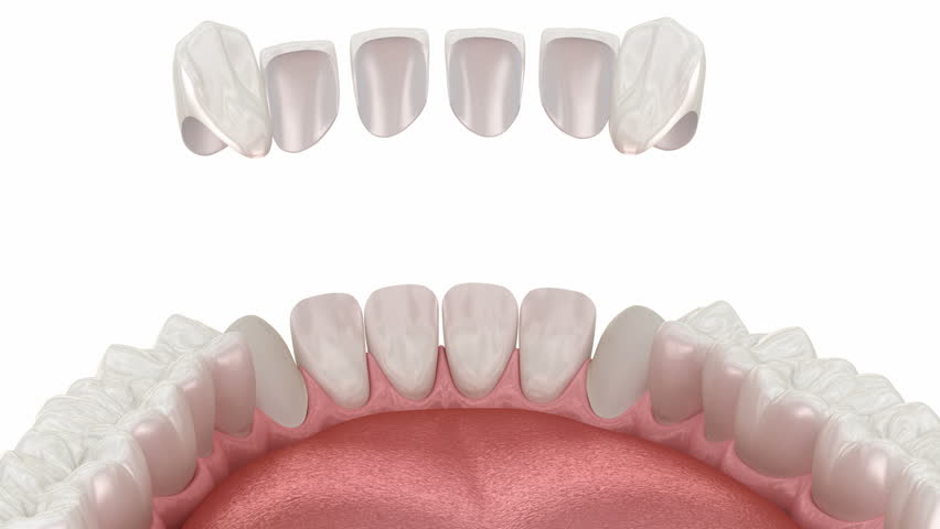 Dental veneer placement procedure. Dental 3D animation Royalty-Free Stock Footage #1101436775