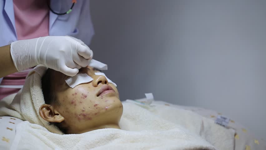 A woman with a severe acne problem on her face. Acne pressing, skin problems that women cannot avoid, acne pressing by skin experts. Problem skin care. | Shutterstock HD Video #1101530605