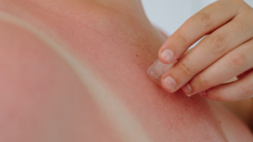 Unrecognizable woman touches reddened, irritated sunburn skin with ice cube, close-up. Ice melts, cool water cools and soothes sensitive skin damaged by ultraviolet rays. Royalty-Free Stock Footage #1101778527