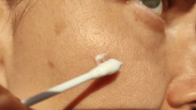 A woman applies a cream with a cotton swab on age spots. Pigmentation on the face. Close-up video. Medicine and cosmetology.