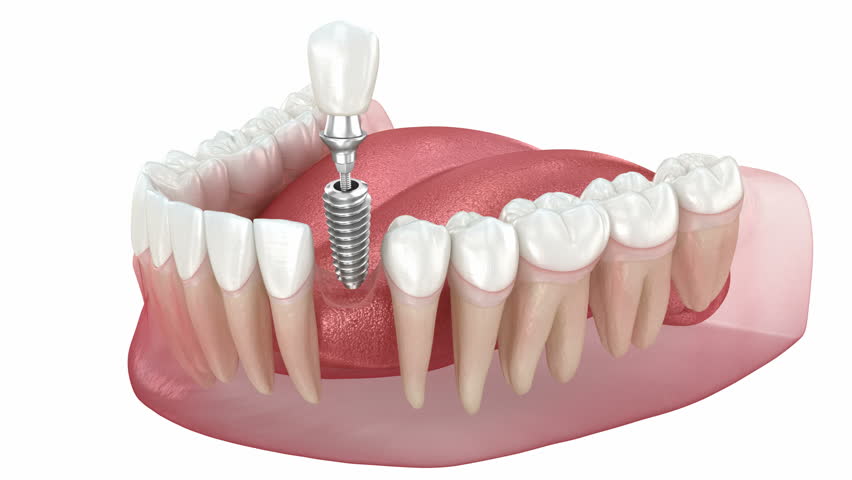 Dental implant installation and crown placement. 3d animation Royalty-Free Stock Footage #1101810571