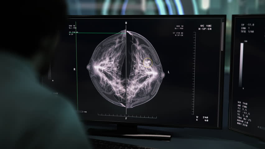 Medical imaging procedure for diagnosis of diseases. Medical imaging of the patients breast for diagnosis. Diagnosis of the dangerous breast cancer after medical mammography imaging. Healthcare. | Shutterstock HD Video #1101950333