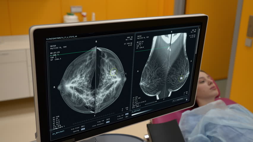 Medical checkup of the female breast during a consultation. Mammography doctor doing a medical checkup on a patient in a consultation. Analysing the chest in a medical checkup consultation. Royalty-Free Stock Footage #1102220399