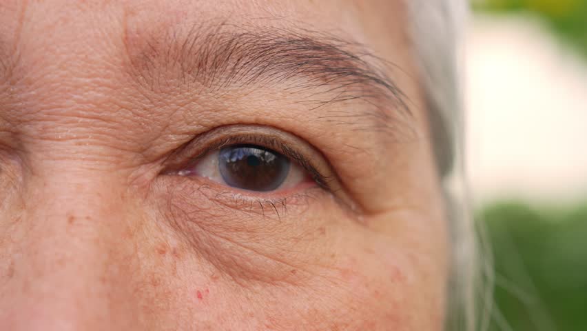 Close up of the senile cataract during eye examination. A white cloudy disc is seen in black eye circle, mature cataract, nuclear sclerosis cataract. Close up half face view Royalty-Free Stock Footage #1102228197