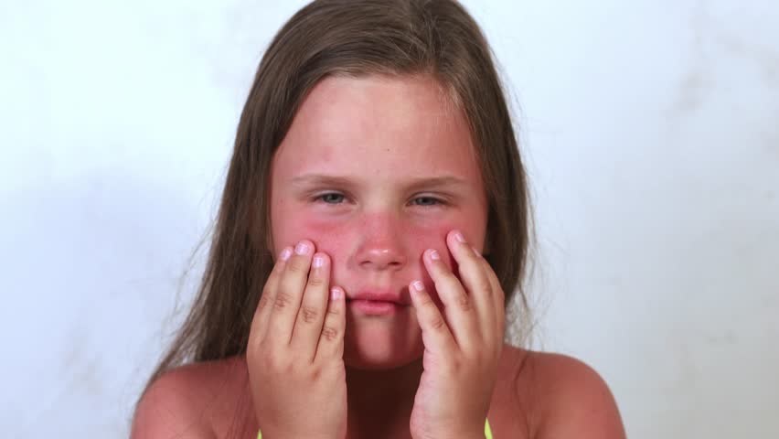 Portrait of poor suffering little girl touching caressing burnt reddened skin on cheeks, complaining on pain, itching on white background. Skin care, UV protection, sunburn, sun block, moisturizing. Royalty-Free Stock Footage #1102278481