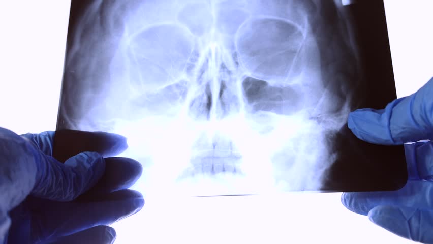 X ray scan of human skull in doctor hands. Ct head scanning on light background in a hospital. Medical research for desease or bones injury test, a Healthcare Video by KatMoys