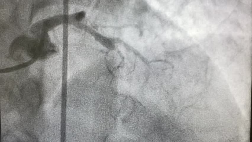 coronary artery angiogram (CAG) was performed  chronic total occlusion (CTO) of  mid left anterior descending artery (LAD) and mid left circumflex artery (LCx) stenosis  Royalty-Free Stock Footage #1102472159