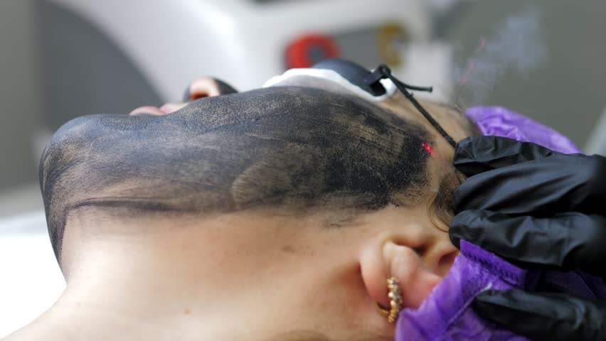 Skin care cosmetology. Laser therapy and skin treatment. Carbon face peeling procedure. Closeup of the laser pulses clean skin of the face. Hardware cosmetology treatment. Process of warming the skin