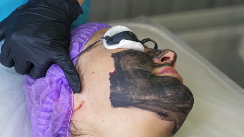 Skin care cosmetology. Laser therapy and skin treatment. Carbon face peeling procedure. Closeup of the laser pulses clean skin of the face. Hardware cosmetology treatment. Process of warming the skin