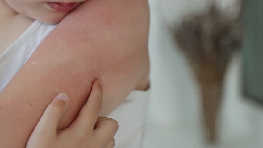 Itchy, irritated skin on child hand after sunburn, close-up. Boy scratches reddened, flaking skin with finger, slow motion. Dermatological disease of unprotected, sensitive skin due to sun exposure. Royalty-Free Stock Footage #1102485439