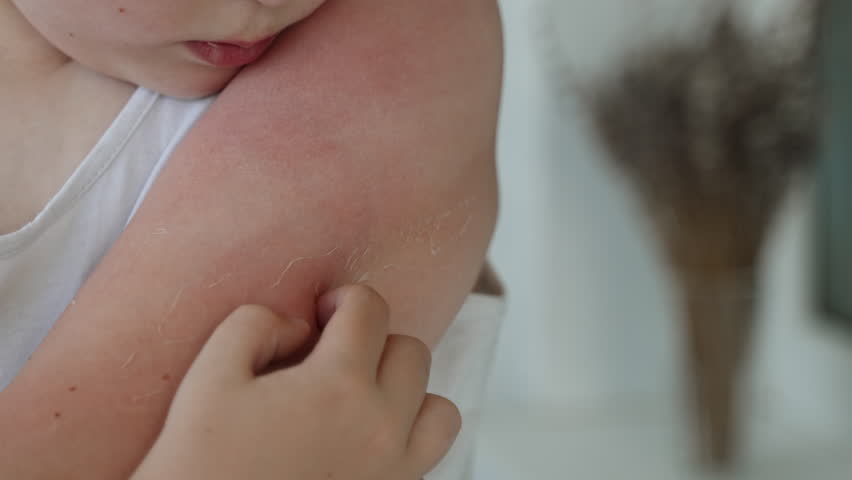 Itchy, irritated skin on child hand after sunburn, close-up. Boy scratches reddened, flaking skin with finger, slow motion. Dermatological disease of unprotected, sensitive skin due to sun exposure. | Shutterstock HD Video #1102485439