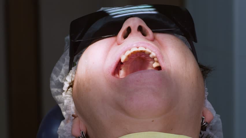 Oral surgeon drilling hole in senior woman gum to open installed dental implant. Dentist with assistant work with a patient in modern dental clinic | Shutterstock HD Video #1102523779