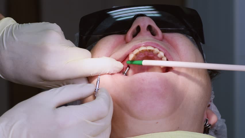 Oral surgeon screwing in transfers to dental implant in senior woman mouth for correct impressions. Dentist and assistant work with a patient in modern dental clinic | Shutterstock HD Video #1102523819