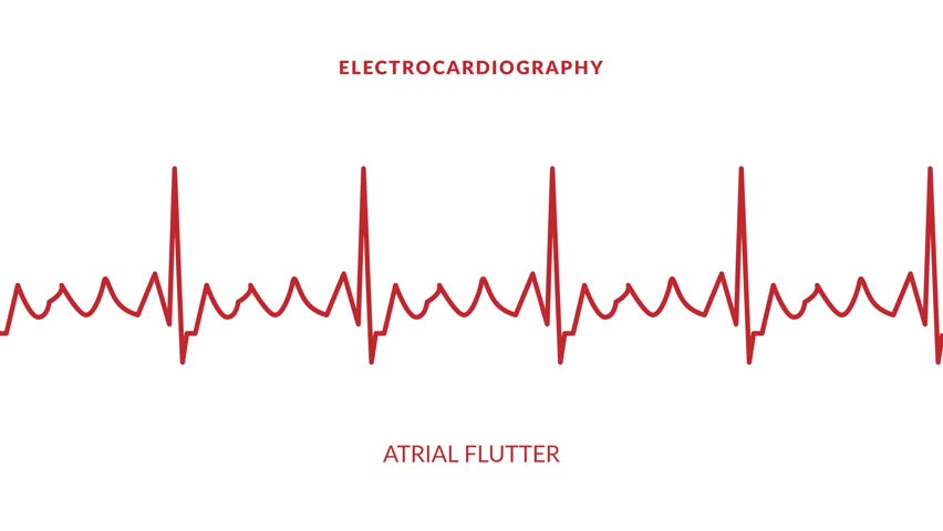 animated atrial flutter. animated ekg display