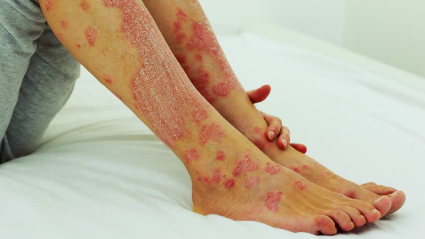 Severe exacerbation of psoriasis. Itching and pain, scratching of wounds. Royalty-Free Stock Footage #1102706473