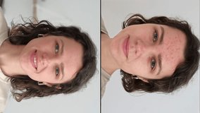 Vertical video. Two faces of young beautiful woman show real result before and after acne treatment. Split screen. Home background. Concept  of acne therapy, scars, inflammation on face, problem skin