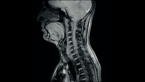 Magnetic Resonance images ( MRI ) of cervical spine sagittal. C5 ,C6, C7 injured disc disease