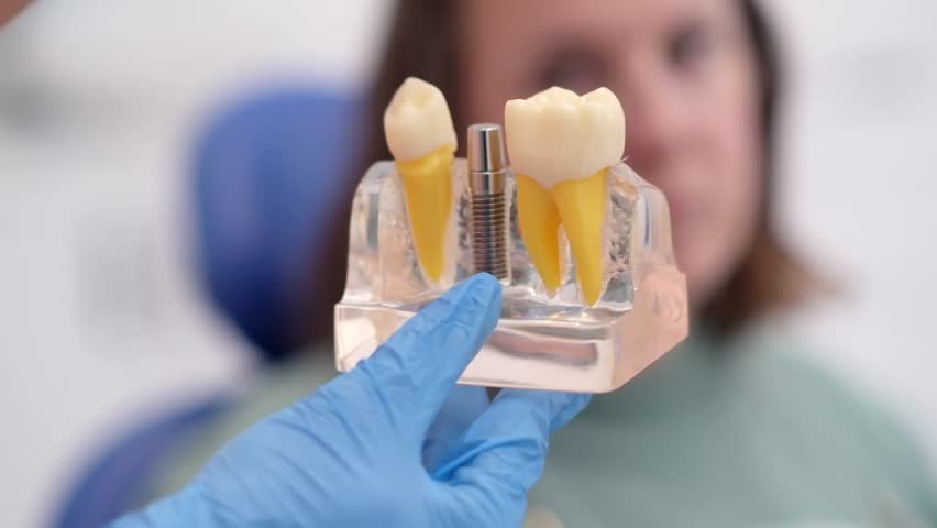 dental implants, dentist discussing a treatment plan with patient holds a dental implant model, emphasizing the importance of patient education in modern dental clinics.  Royalty-Free Stock Footage #1102762711