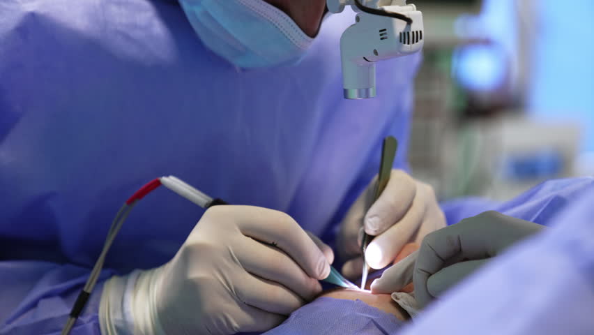 Doctor with headlight on head uses metal tool and electric device in surgery. Eyelid operation close up. Royalty-Free Stock Footage #1102932525