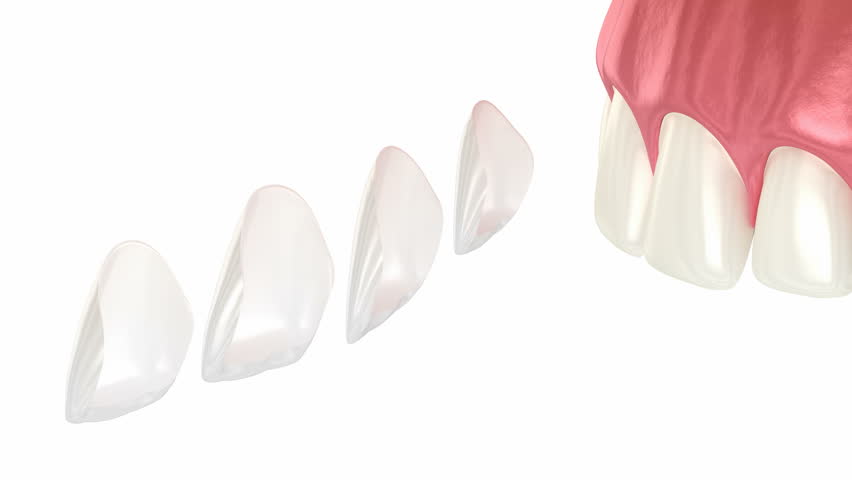 Dental veneer placement procedure. Dental 3D animation Royalty-Free Stock Footage #1102944209
