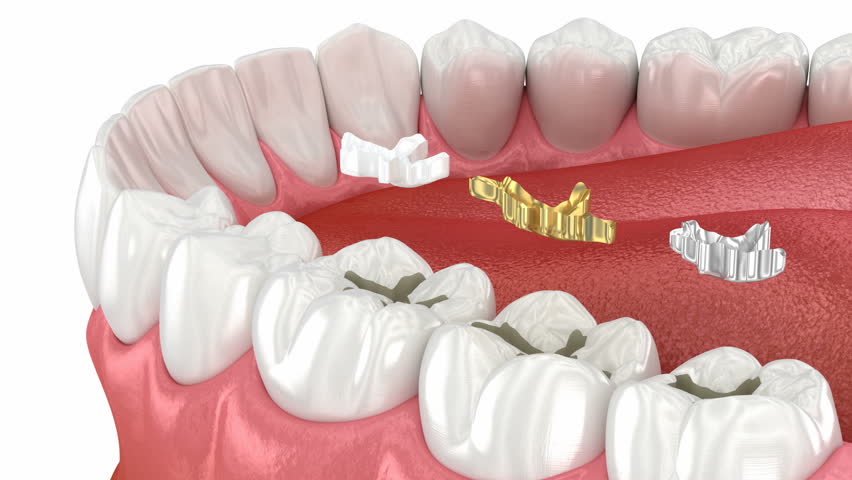 Dental fillings: ceramic, golden, metal. Dental 3D animation Royalty-Free Stock Footage #1102944211