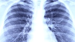 Blue medical x ray of chest scan on light background. Covid desease, cancer examination, pneumonia, asthma and tuberculosis diagnostic concept - Powered by Shutterstock - Get 15% off with code: PIKWIZARD15