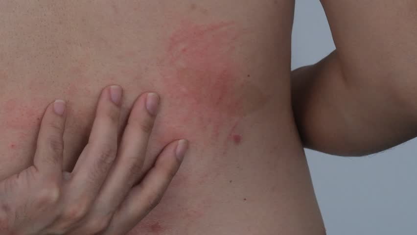 A man scratching his allergic hives skin on back | Shutterstock HD Video #1103164817