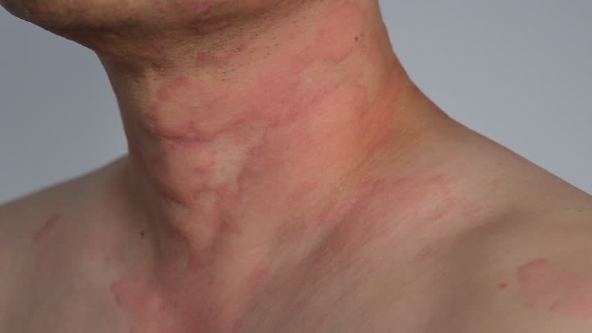 Close up image of skin texture suffering severe urticaria or hives or kaligata on neck. Allergy symptoms. Royalty-Free Stock Footage #1103292677