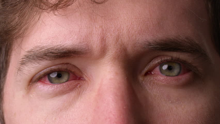 Man with pink eye looks towards camera and blinks - close up on eyes Royalty-Free Stock Footage #1103812311