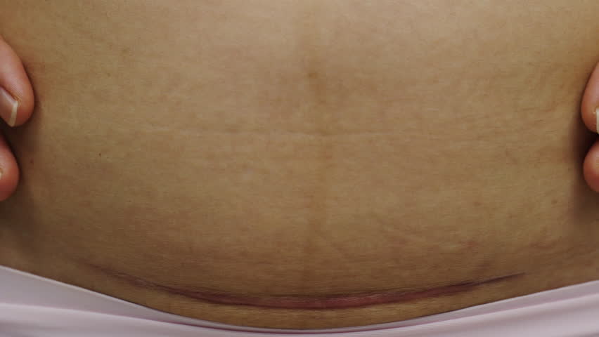 close up belly of woman with a c-section scar of caesarean Royalty-Free Stock Footage #1104172443