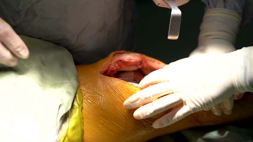 Knee operation. Endoprosthesis. surgery 4 K
 Royalty-Free Stock Footage #1104300215