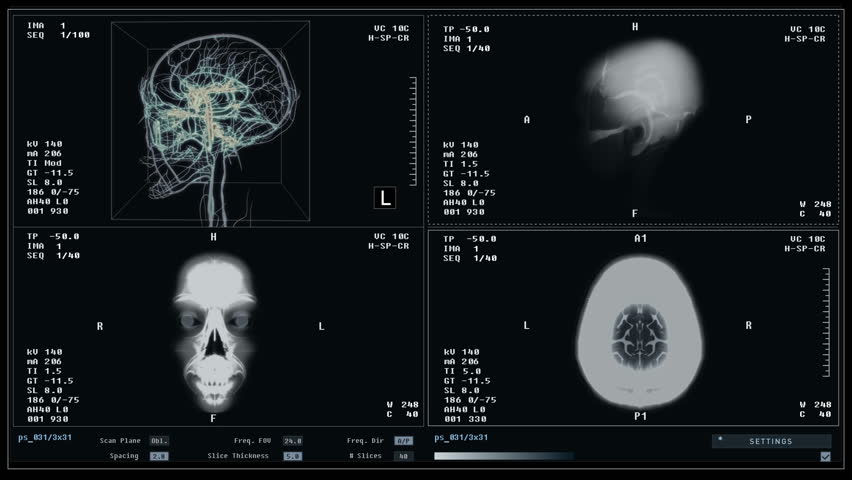 Diagnostic system deals with organ examination by scanning head. Diagnostic examination of the human organs. Medical diagnostic software thoroughly examining the damaged patients brain organ. X-ray. Royalty-Free Stock Footage #1104588485