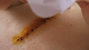 Abdomen of young girl. Closeup video of girl's hand is changing bandage after the abdominal surgery for umbilical and inguinal hernias. Irritation from the patch. Postoperative recover.