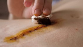 Abdomen of young girl. Closeup video of the long scar above navel after abdominal surgery for umbilical and inguinal hernias. Woman is treating the scar with betadine. Postpartum recovery.