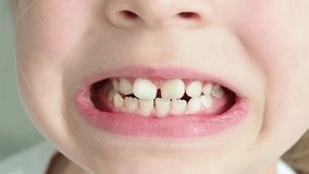 Children's teeth are large. Wide open mouth in a smile. Malocclusion in a child. Crooked front teeth. Pediatric dentistry concept, teaching material for dentists.