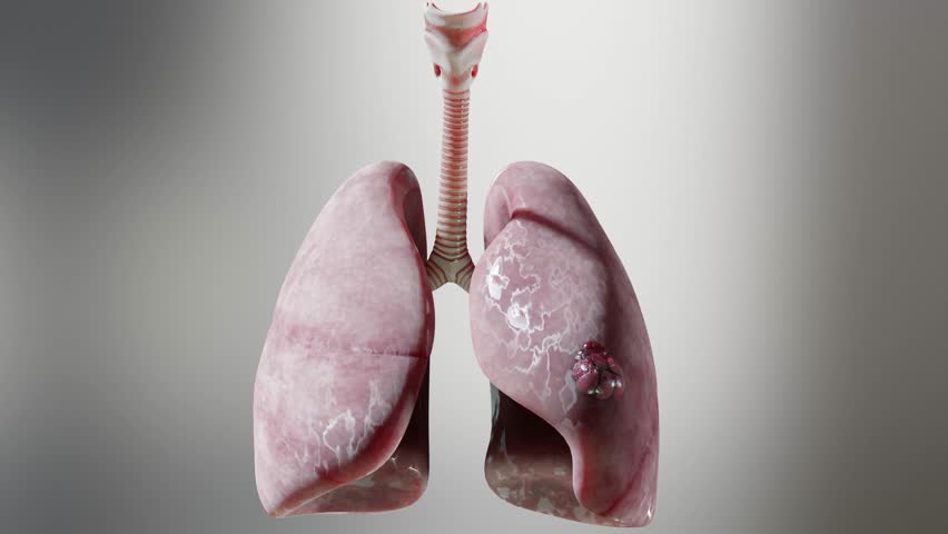 Pneumonia illness, healthy lungs and disease lungs, Human Lungs cancer, Cigarette smokers Lung disease, cancerous malignant tumor growing and spreading, respiratory system, asthma infection, 3d render | Shutterstock HD Video #1105326791