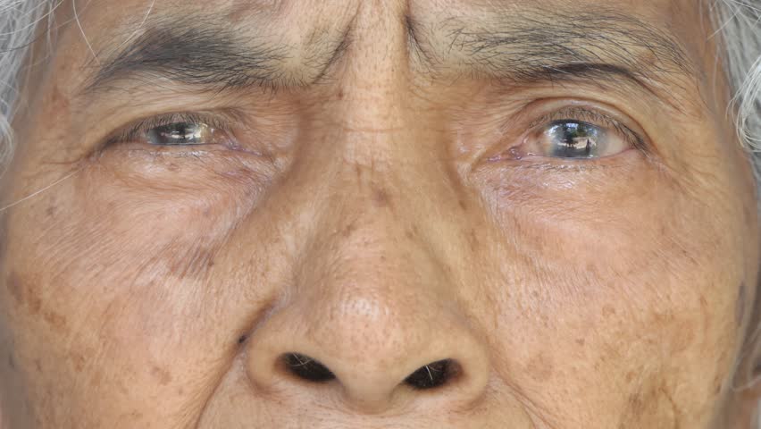 The eyes of the elderly are cataracts.  Royalty-Free Stock Footage #1105434607