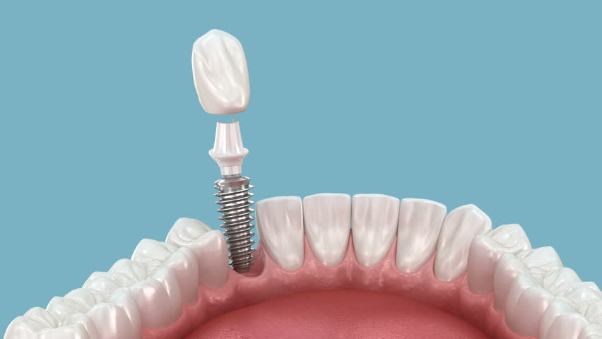Dental implant installation and crown placement. 3d animation Royalty-Free Stock Footage #1105442259
